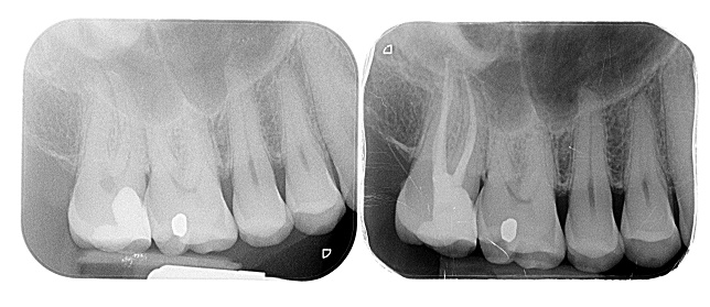 Root Canal (Endodontic) Treatment Croydon