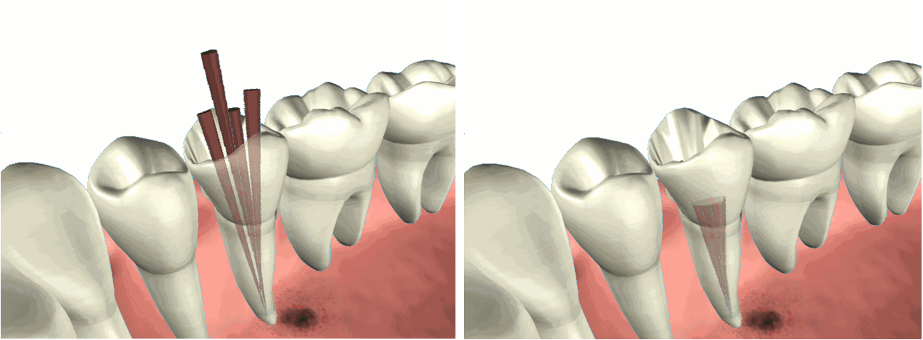 Root Canal (Endodontic) Treatment Croydon