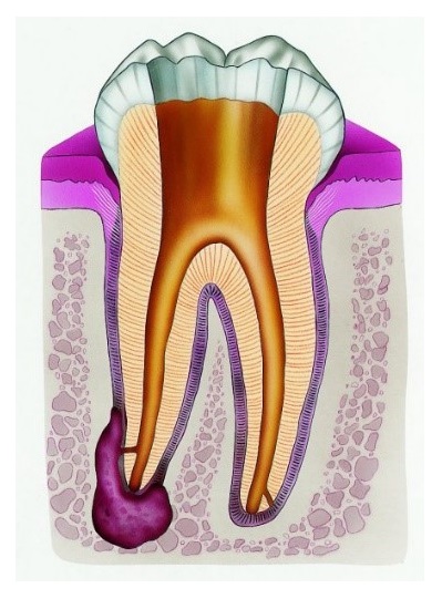 Root Canal (Endodontic) Treatment Croydon