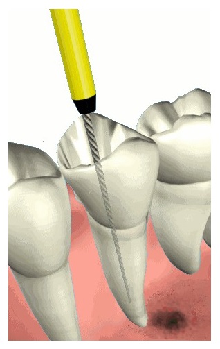Root Canal (Endodontic) Treatment Croydon